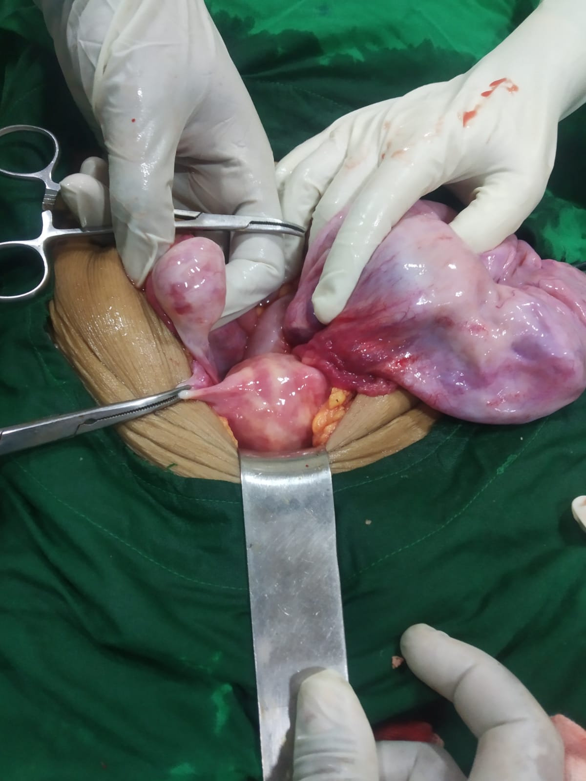 overian-cyst1